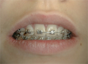 Appareil dentaire bagues métalliques