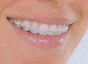 Appareil dentaire attaches transparentes