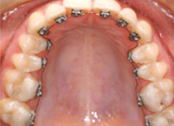 Orthodontie linguale, attaches face interne des dents