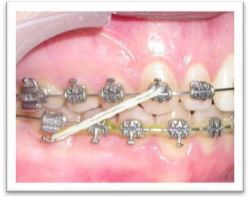 Elastisques de l'appareil dentaire