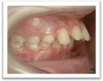 Ecarts des incisives supérieures et inférieures causant des difficultés de mastication