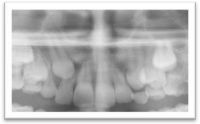 Canines incluses avec risque de résorption de l'incisive latérale