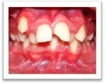 Malpositions dentaires, dissymétrie faciale majeure