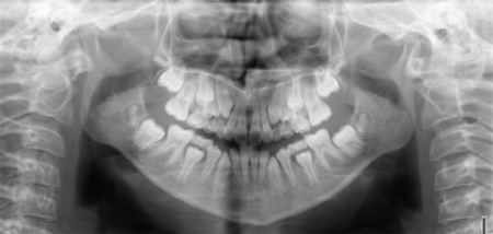 Radiographie panoramique