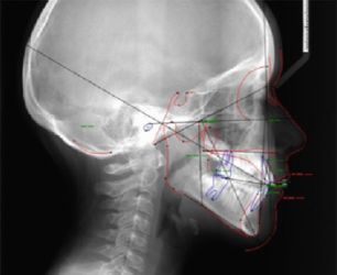 Téléradiographie de profil