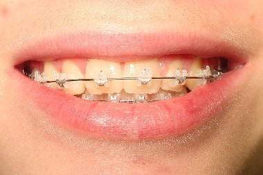 Bagues dentaires en céramique