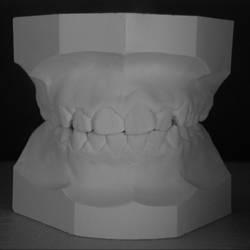 Moulage des dents